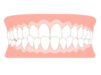 反対咬合_受け口_クロスバイト_交叉咬合_切端咬合