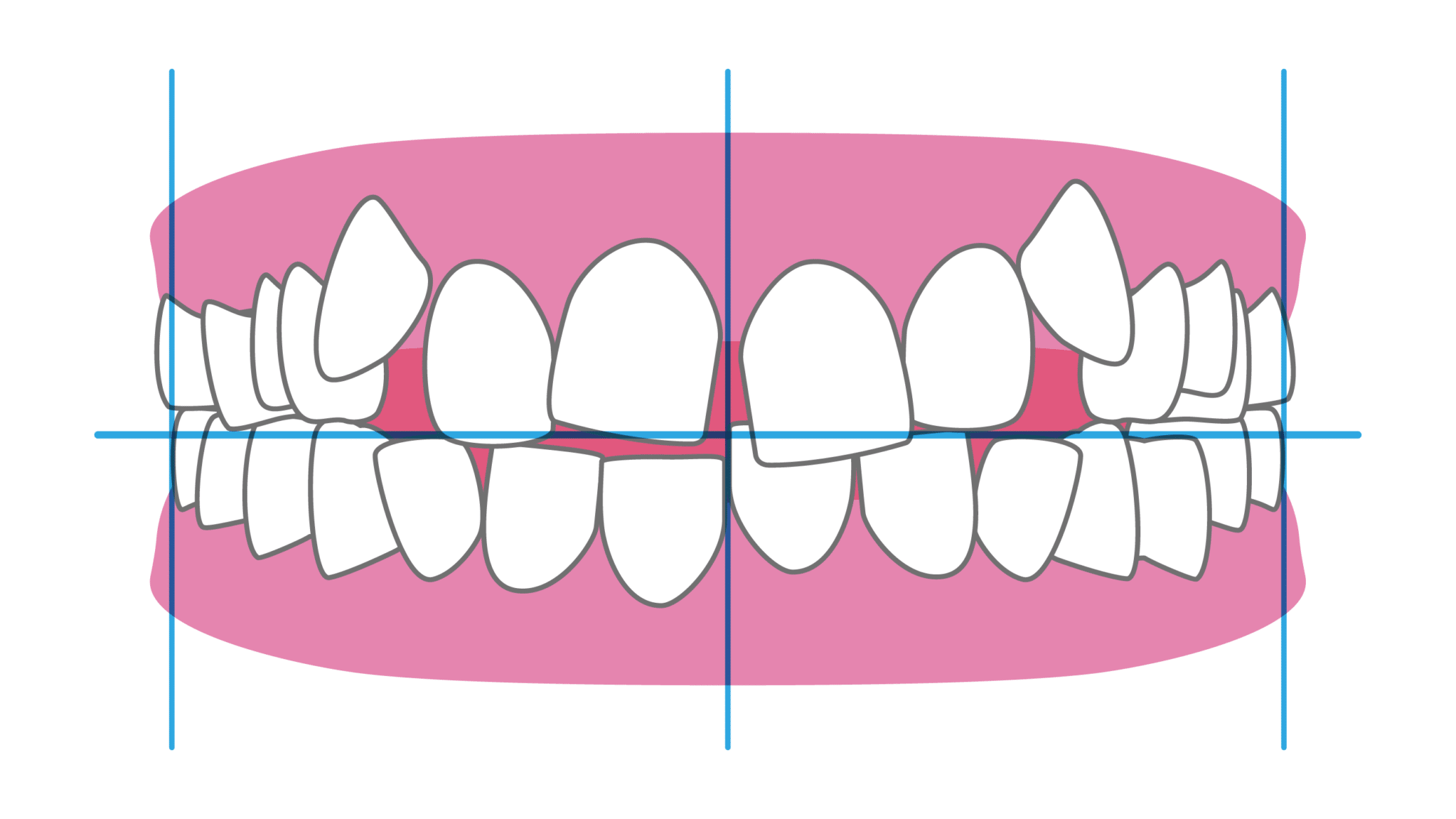 叢生（デコボコ）の症例写真