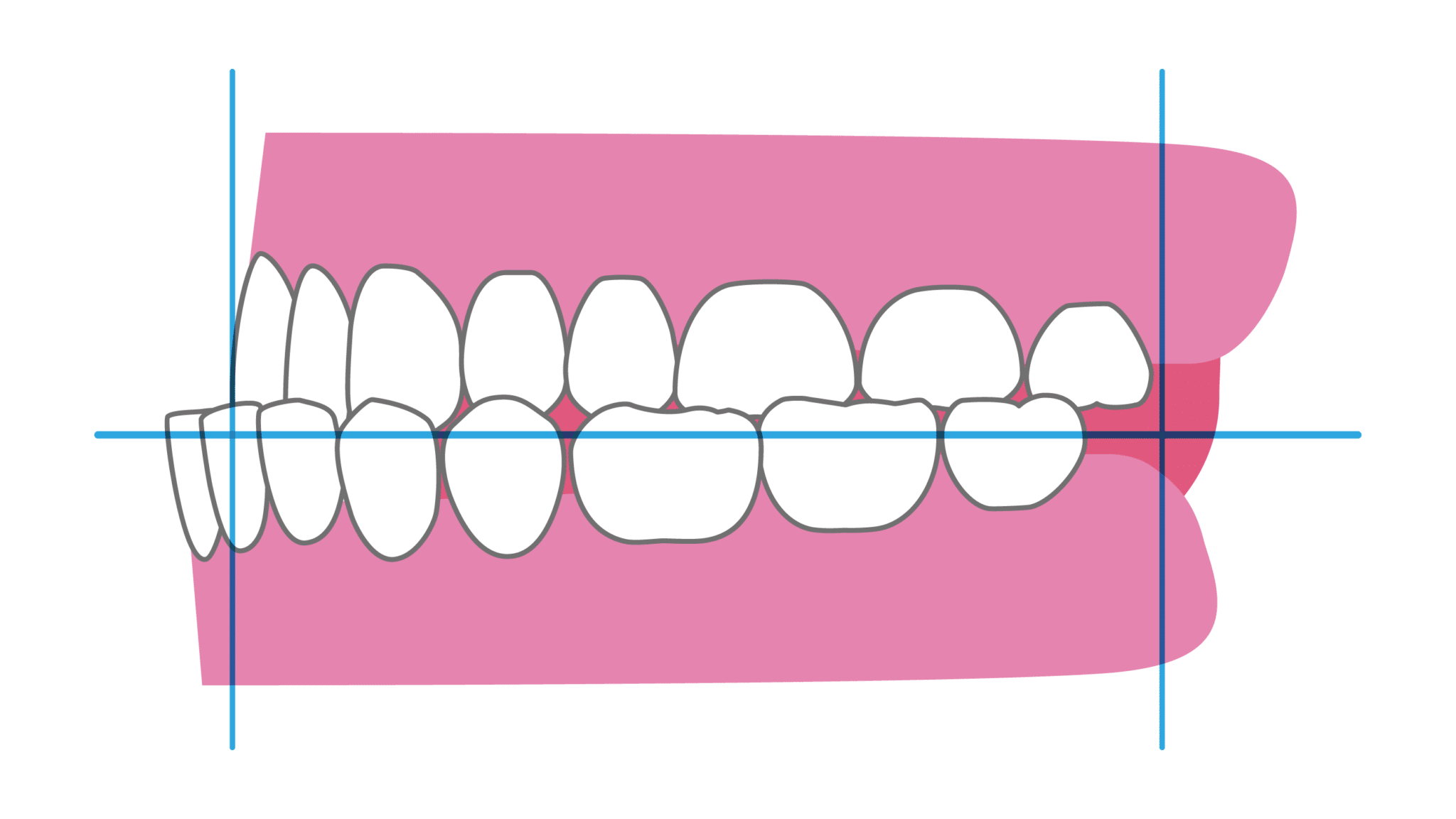 反対咬合（受け口）の症例写真
