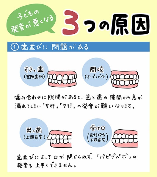 サ行とタ行が言えない_3_子供の滑舌が悪い原因と歯並びの関係について解説するイラスト