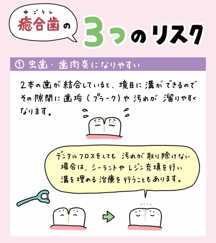 歯科検診で癒合歯と診断されたら？_3_子供の歯の癒合歯について解説するイラスト