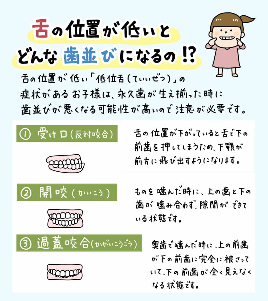 舌の位置が低い子供は_5_舌の低い位置が口腔健康に及ぼす影響について学ぶ子供のイラスト解説