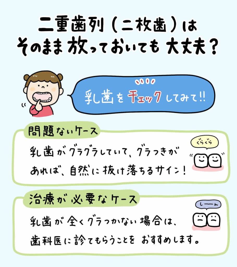 子供の二重歯列（二枚歯）とは？_3_子供の二重歯列（二枚歯）の状態とその治療法についての詳細なイラスト解説