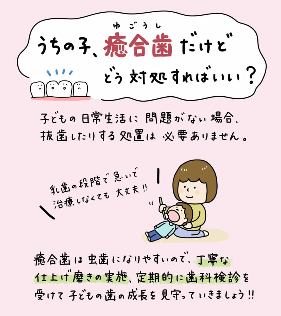 歯科検診で癒合歯と診断されたら？_6_子供の歯の癒合歯について解説するイラスト