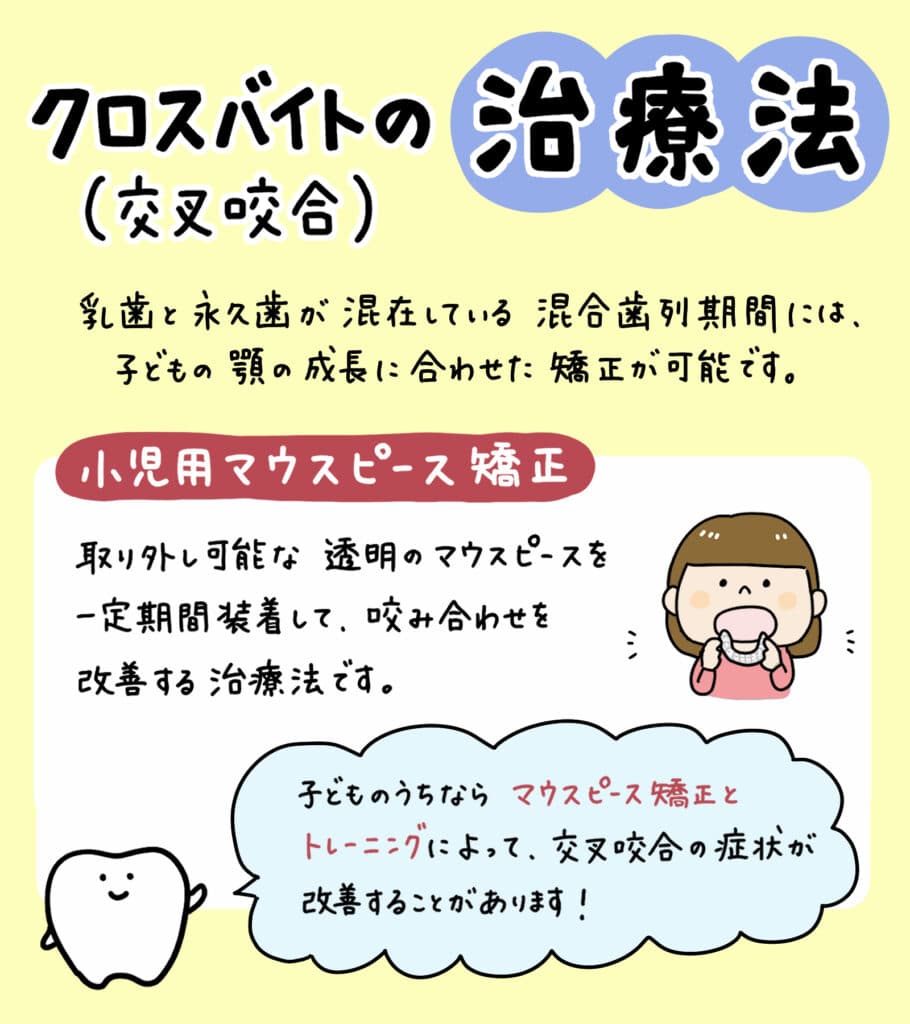 子どもが交叉咬合_5_子供の交叉咬合（クロスバイト）の原因と治療法を解説するイラスト