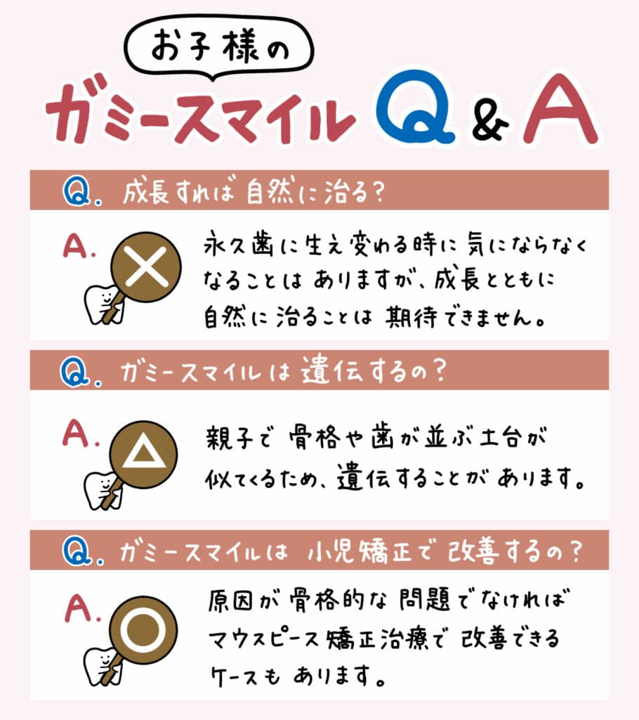 笑うと歯茎が見える_2_ガミースマイルとは何か、およびその原因と治療法を説明するイラスト解説