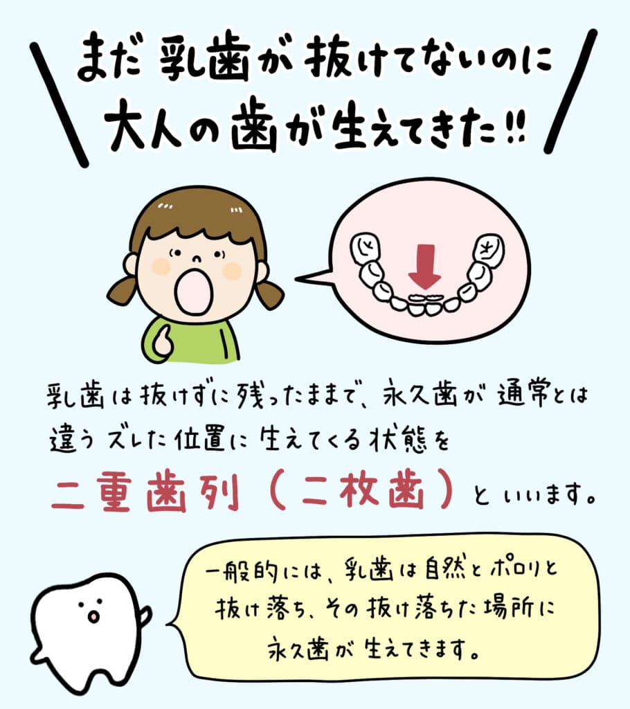 子供の二重歯列（二枚歯）とは？_1_子供の二重歯列（二枚歯）の状態とその治療法についての詳細なイラスト解説