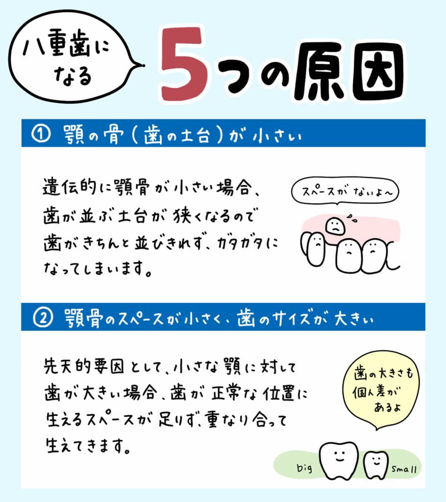 子供の八重歯が変な位置から_3_子供の八重歯の対処法と治療法を解説する記事のイラスト解説画像