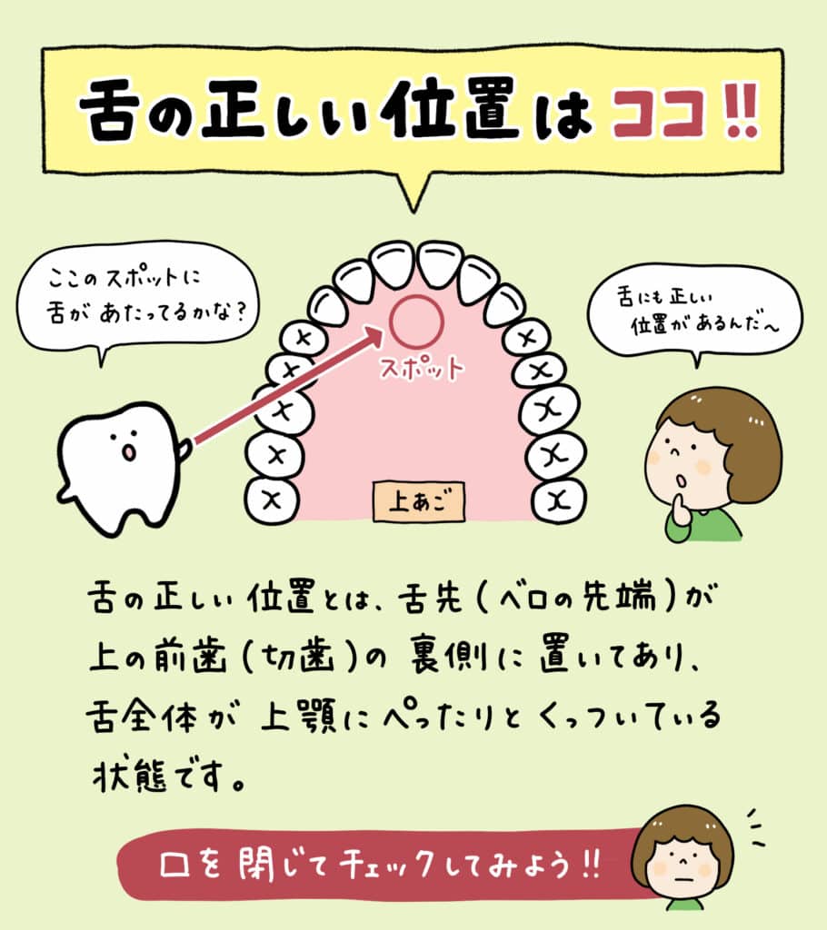 自宅でカンタン舌トレ_1_子供の舌トレーニング法を図解したイラスト。正しい舌の位置、あいうべ体操、音鳴らし、風船遊びなどのトレーニング方法、小児矯正における舌トレの重要性を視覚的に説明。