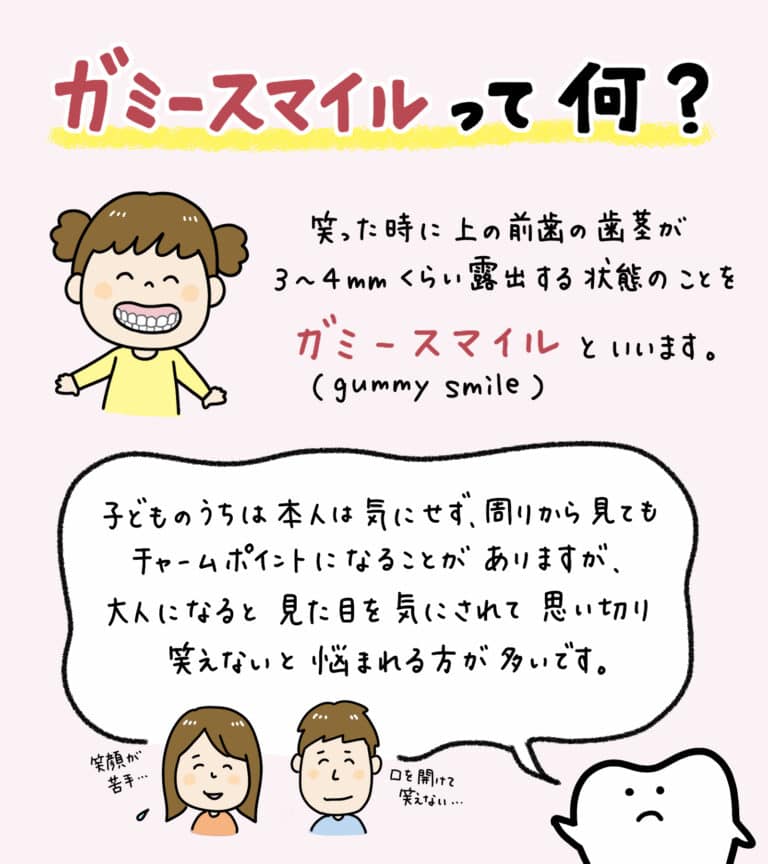 笑うと歯茎が見える_1_ガミースマイルとは何か、およびその原因と治療法を説明するイラスト解説