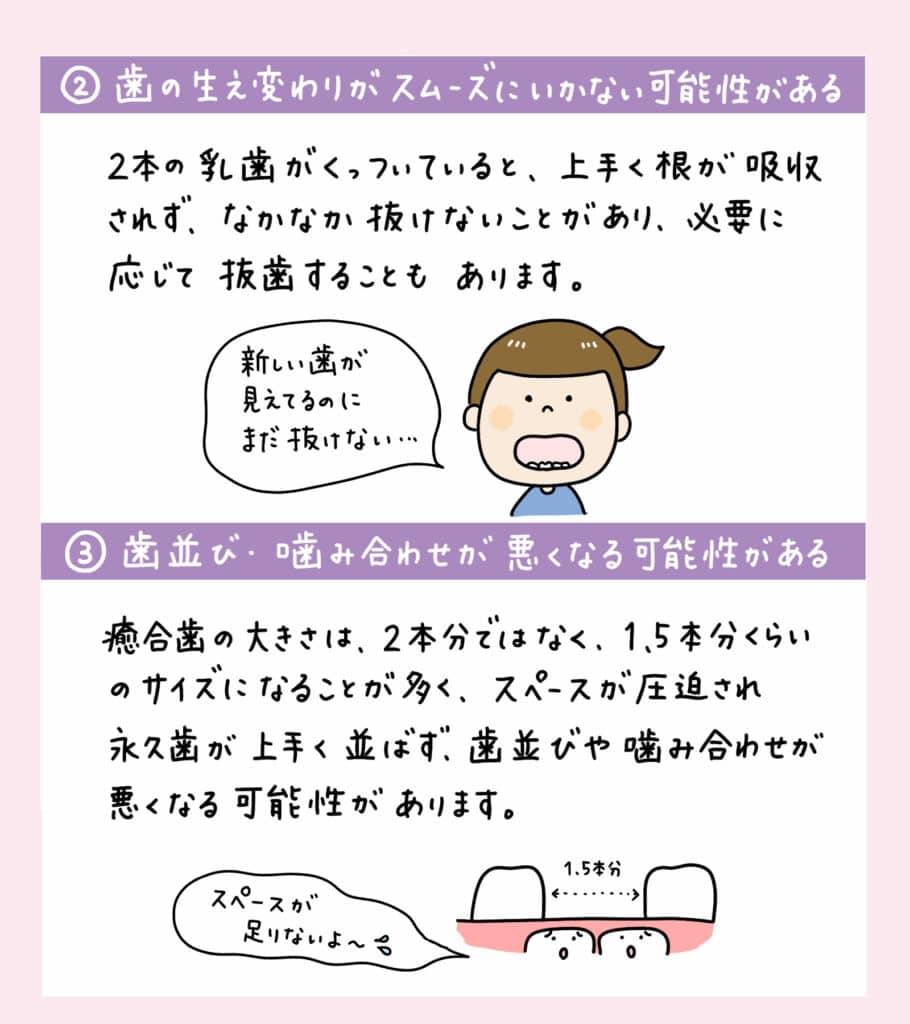 歯科検診で癒合歯と診断されたら？_4_子供の歯の癒合歯について解説するイラスト