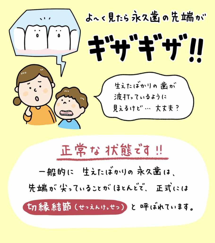 子供の生えた歯ギザギザ_1_子供の新しい永久歯が尖っていたりギザギザしている様子と、その状態が正常であることを説明しているイラスト