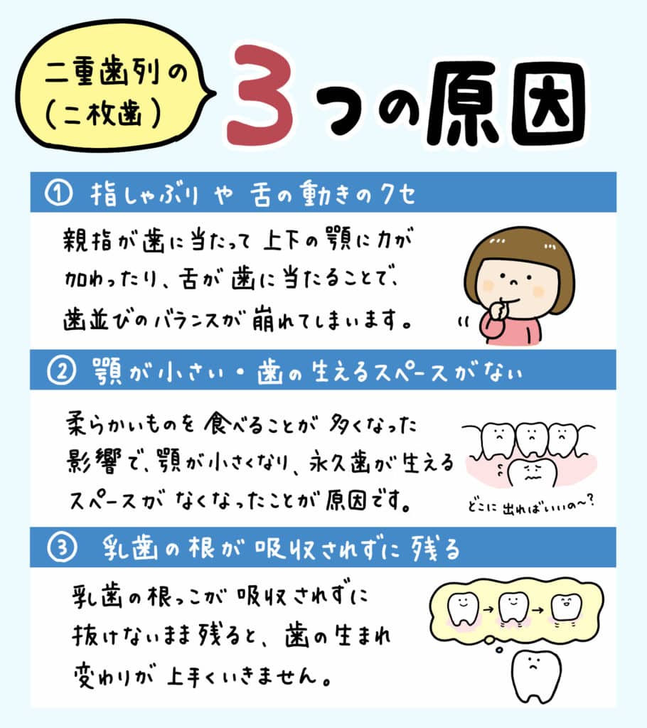 子供の二重歯列（二枚歯）とは？_2_子供の二重歯列（二枚歯）の状態とその治療法についての詳細なイラスト解説