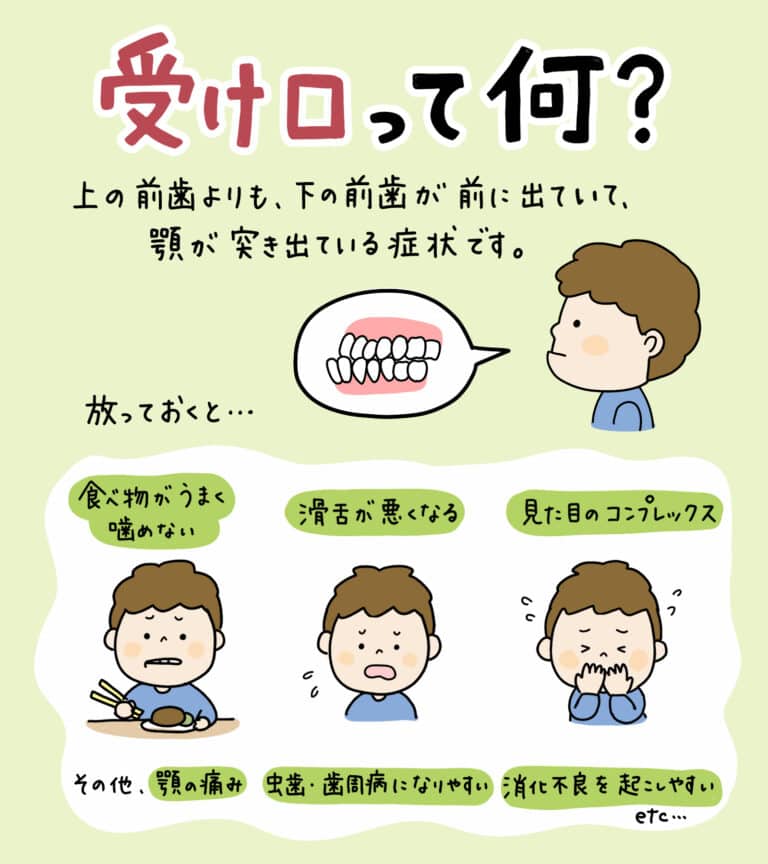 子供の受け口(反対咬合)_1_小児歯科医が子供の反対咬合（受け口）の状態と矯正方法を解説するイラスト