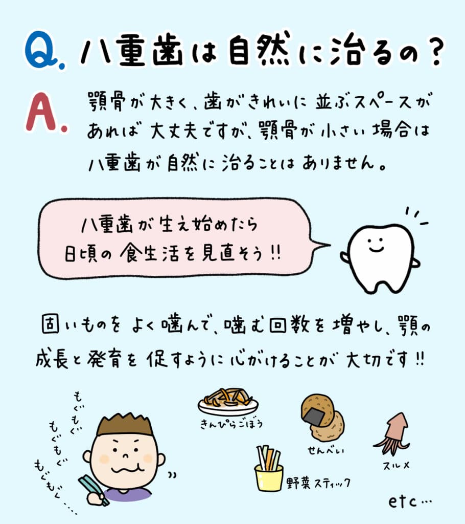 子供の八重歯が変な位置から_2_子供の八重歯の対処法と治療法を解説する記事のイラスト解説画像