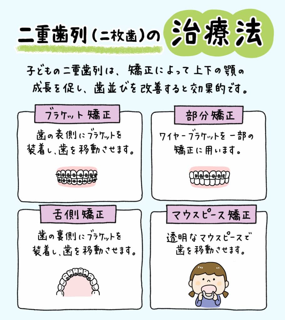 子供の二重歯列（二枚歯）とは？_5_子供の二重歯列（二枚歯）の状態とその治療法についての詳細なイラスト解説