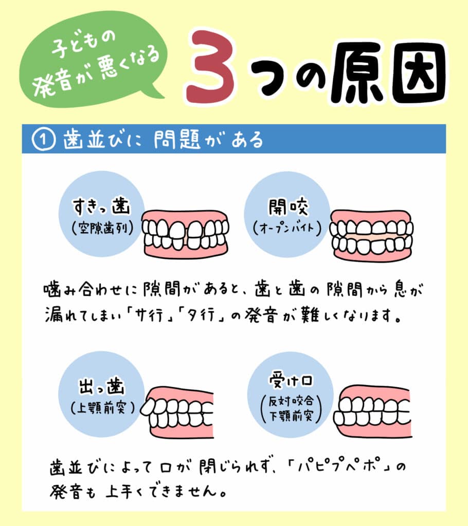 サ行とタ行が言えない_3_子供の滑舌が悪い原因と歯並びの関係について解説するイラスト