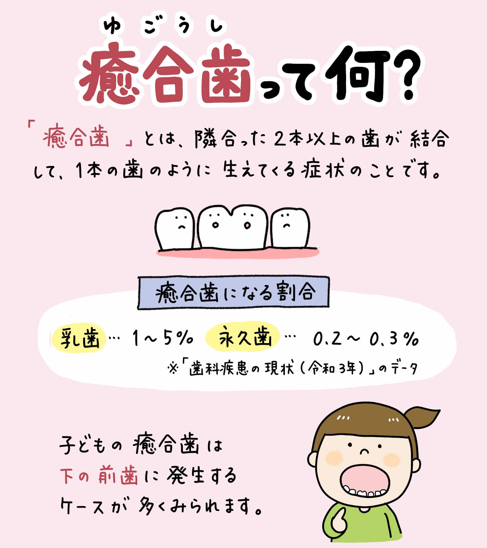 歯科検診で癒合歯と診断されたら？_1_子供の歯の癒合歯について解説するイラスト