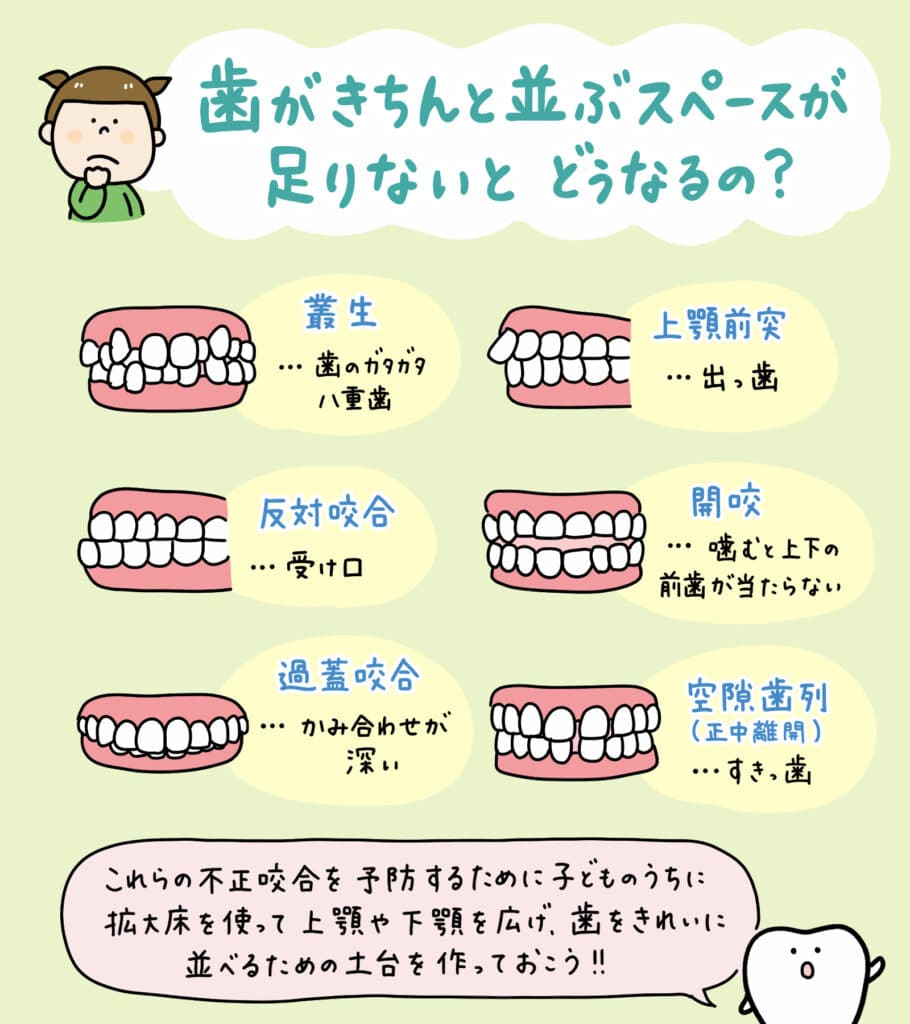 床矯正 拡大床を使うと_2_拡大床による床矯正の仕組みと顔への影響を説明するイラスト。顎の拡大と歯列矯正の過程を示し、顔の輪郭が変わらないことを視覚的に解説。