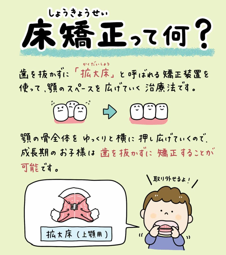 床矯正 拡大床を使うと_1_拡大床による床矯正の仕組みと顔への影響を説明するイラスト。顎の拡大と歯列矯正の過程を示し、顔の輪郭が変わらないことを視覚的に解説。