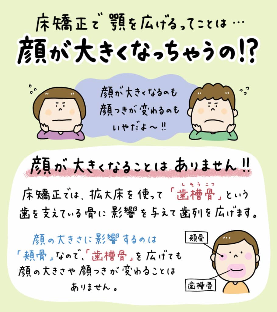 床矯正 拡大床を使うと_3_拡大床による床矯正の仕組みと顔への影響を説明するイラスト。顎の拡大と歯列矯正の過程を示し、顔の輪郭が変わらないことを視覚的に解説。