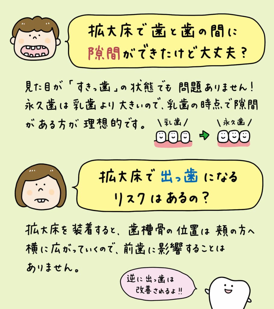 床矯正 拡大床を使うと_4_拡大床による床矯正の仕組みと顔への影響を説明するイラスト。顎の拡大と歯列矯正の過程を示し、顔の輪郭が変わらないことを視覚的に解説。