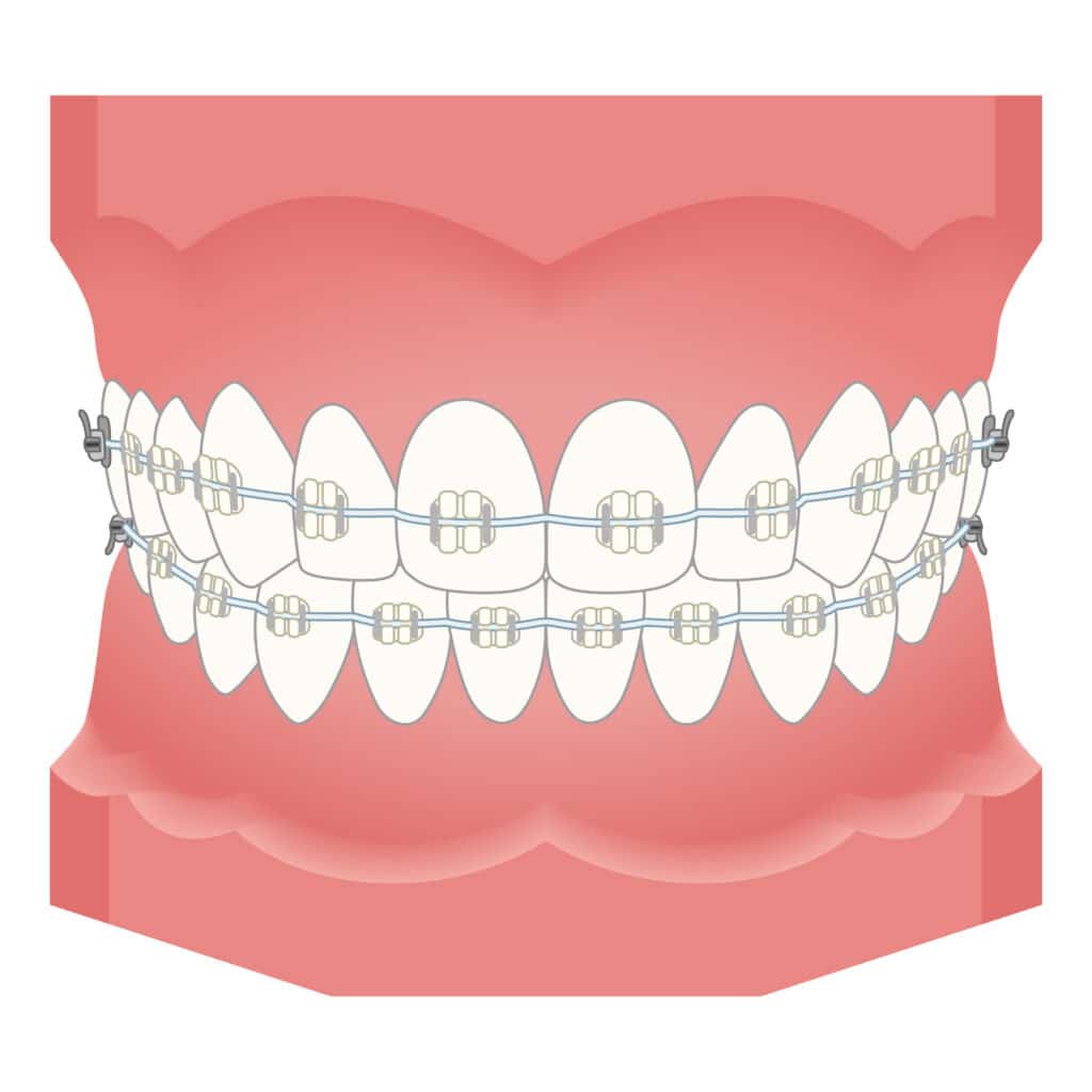 ワイヤー矯正_歯列矯正_矯正器具