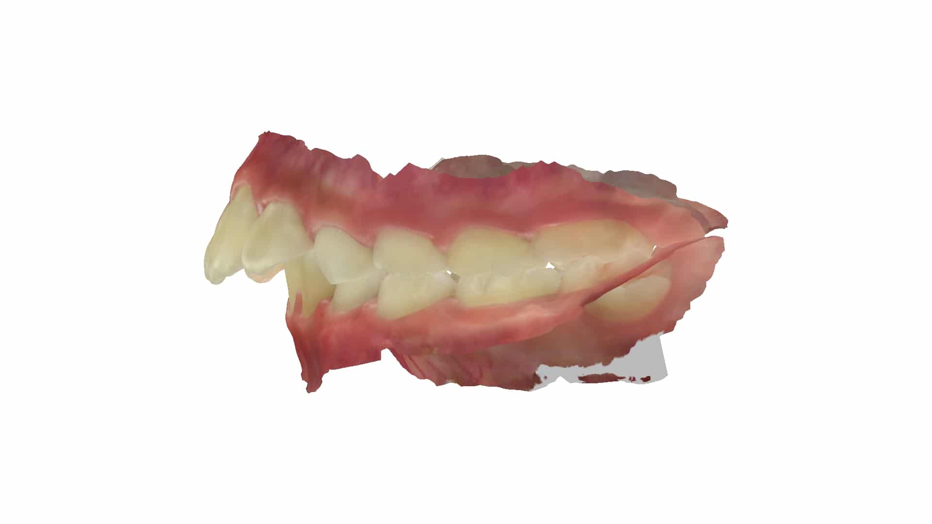 上顎前突 治療前 側面（9歳7ヶ月）