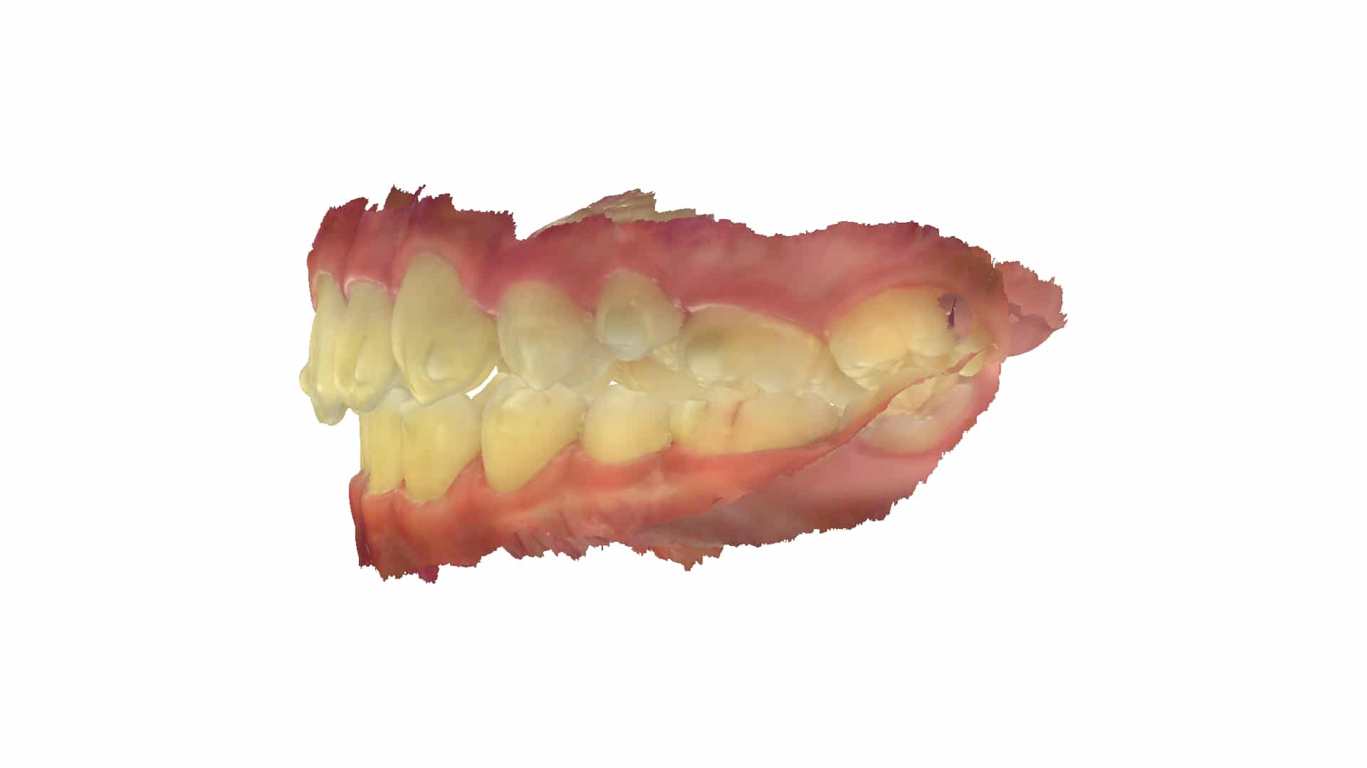 上顎前突 治療後 側面（13歳9ヶ月）