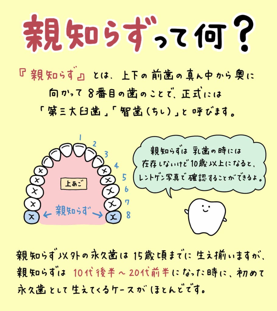 親知らずと歯並びの関係_2_親知らずが子どもの歯並びに影響するかどうか？についての解説イラスト
